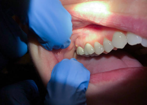 Best Knocked-Out Tooth Emergency  in Olney, IL