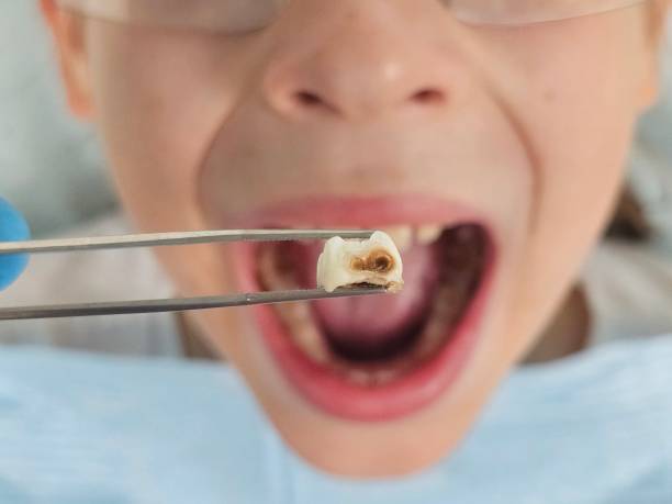 Best Emergency Tooth Extraction  in Olney, IL
